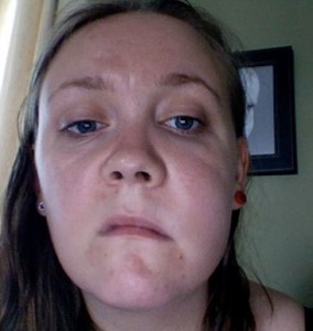 A woman with facial swelling from a dental abscess
