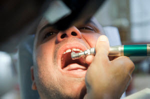 dentist fixing broken tooth