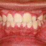 A patient with gingivitis which is a sign of periodontal disease